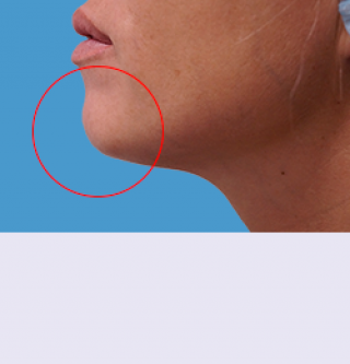 Контурная пластика до | пациент 54