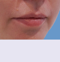 Контурная пластика до | пациент 78