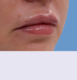 Контурная пластика после | пациент 78