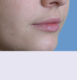 Контурная пластика до | пациент 74