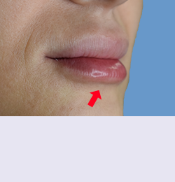 Контурная пластика после | пациент 66