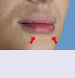 Контурная пластика после | пациент 65