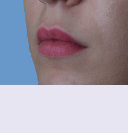 Контурная пластика до | пациент 61