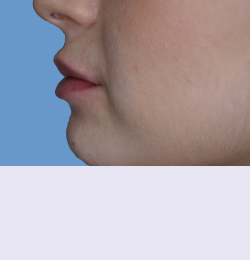 Контурная пластика после | пациент 49