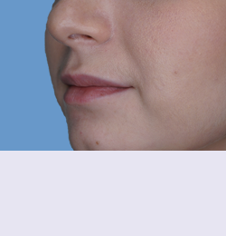 Контурная пластика до | пациент 48