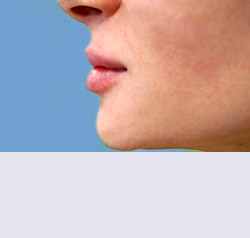 Контурная пластика после | пациент 32