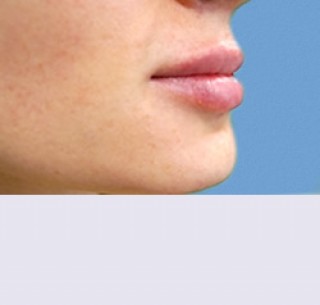 Контурная пластика после | пациент 30