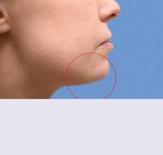 Контурная пластика после | пациент 13